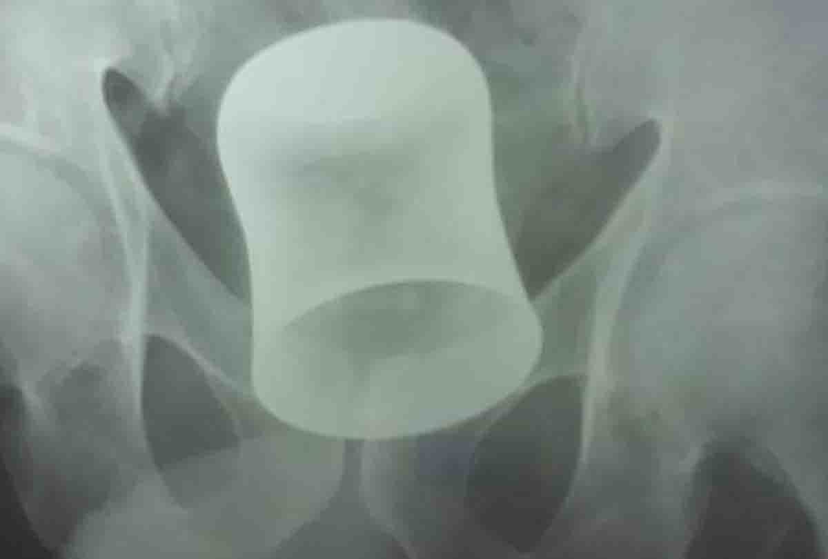 Steel glass out from patient's stomach