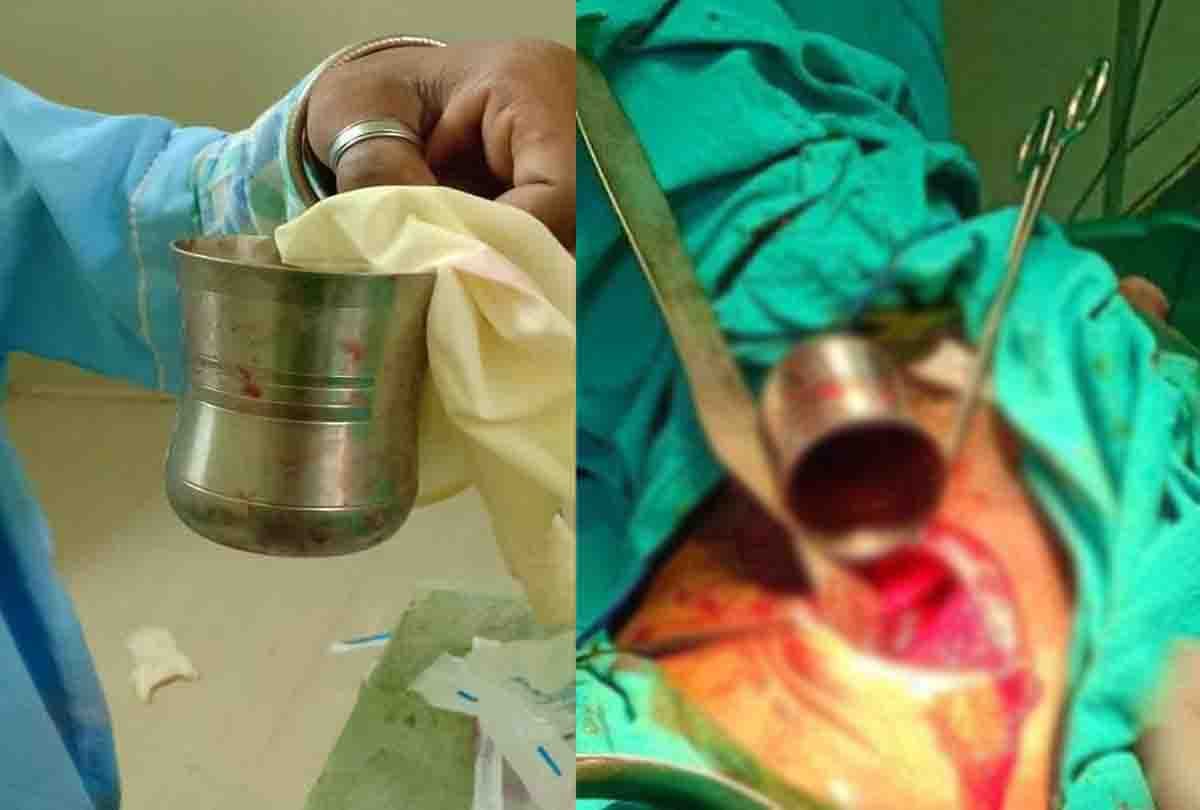 Steel glass out from patient's stomach