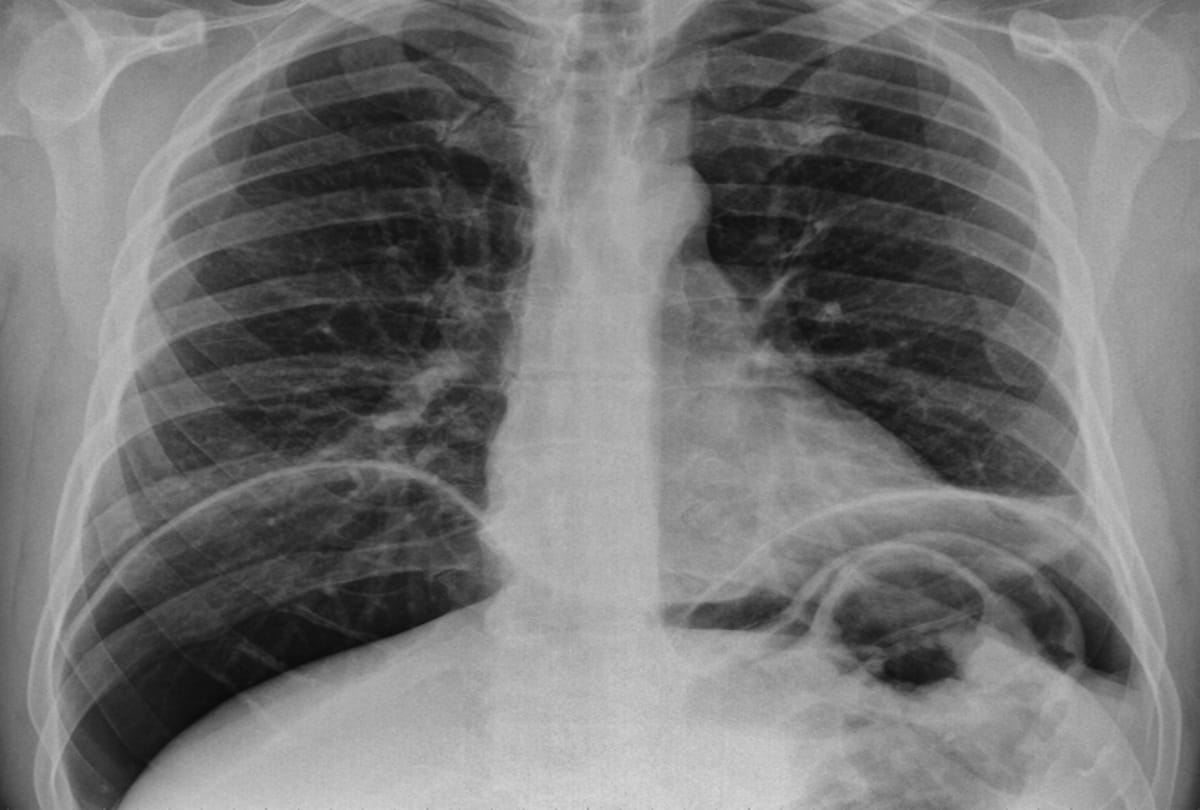 doctors operated child suffering from hemi trunks disease by using cow veins