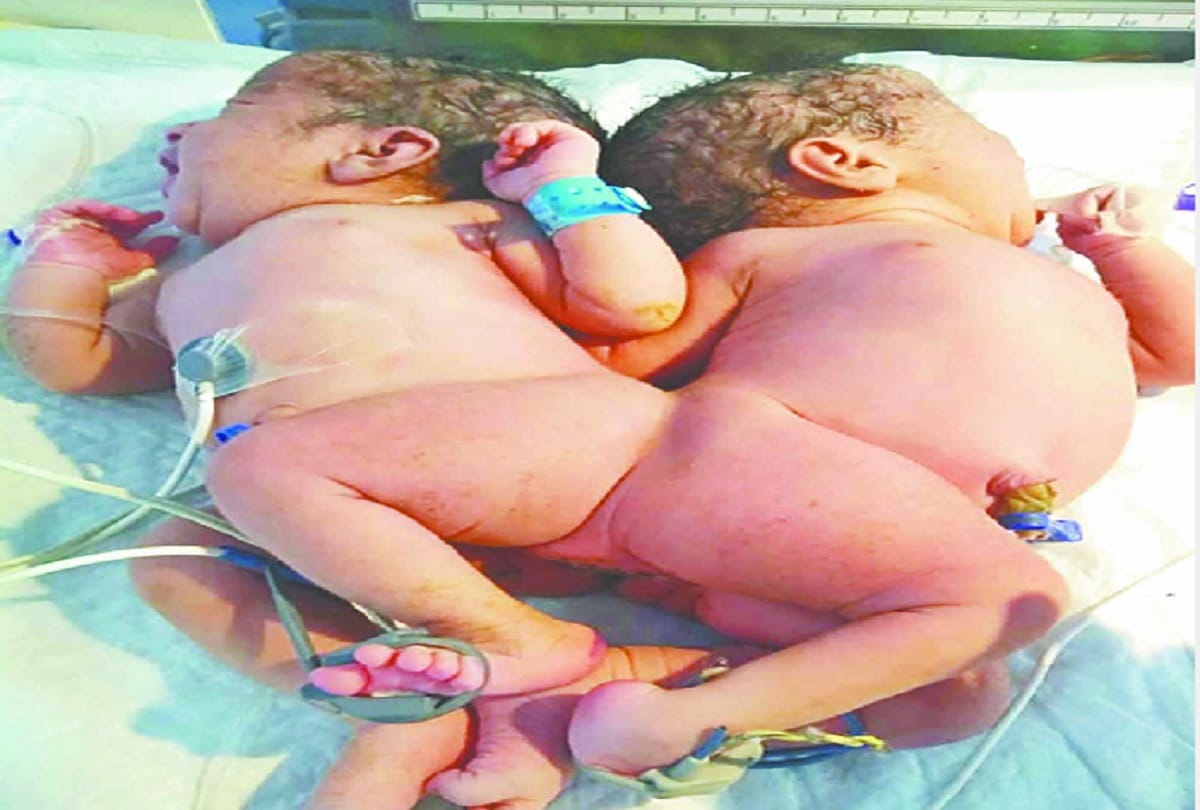 AIIMS doctors team will complex surgeries of two UP girls after Two months