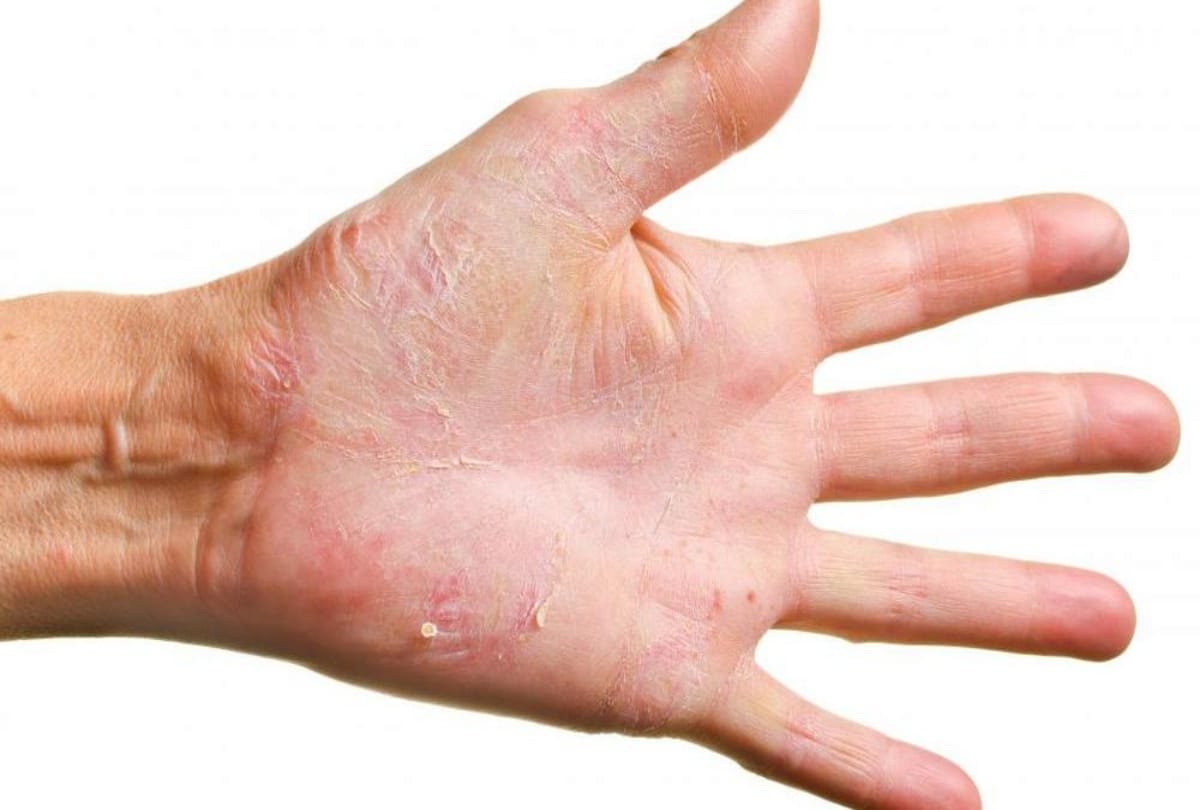 natural home treatment for peeling skin