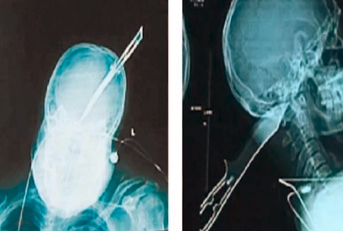 Man drive bike himself with Eight inches knife in his head arrived at police station