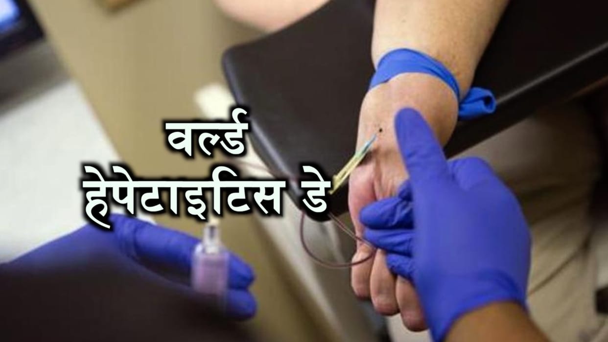 world hepatitis day ten hepatitis patients found every month in Agra