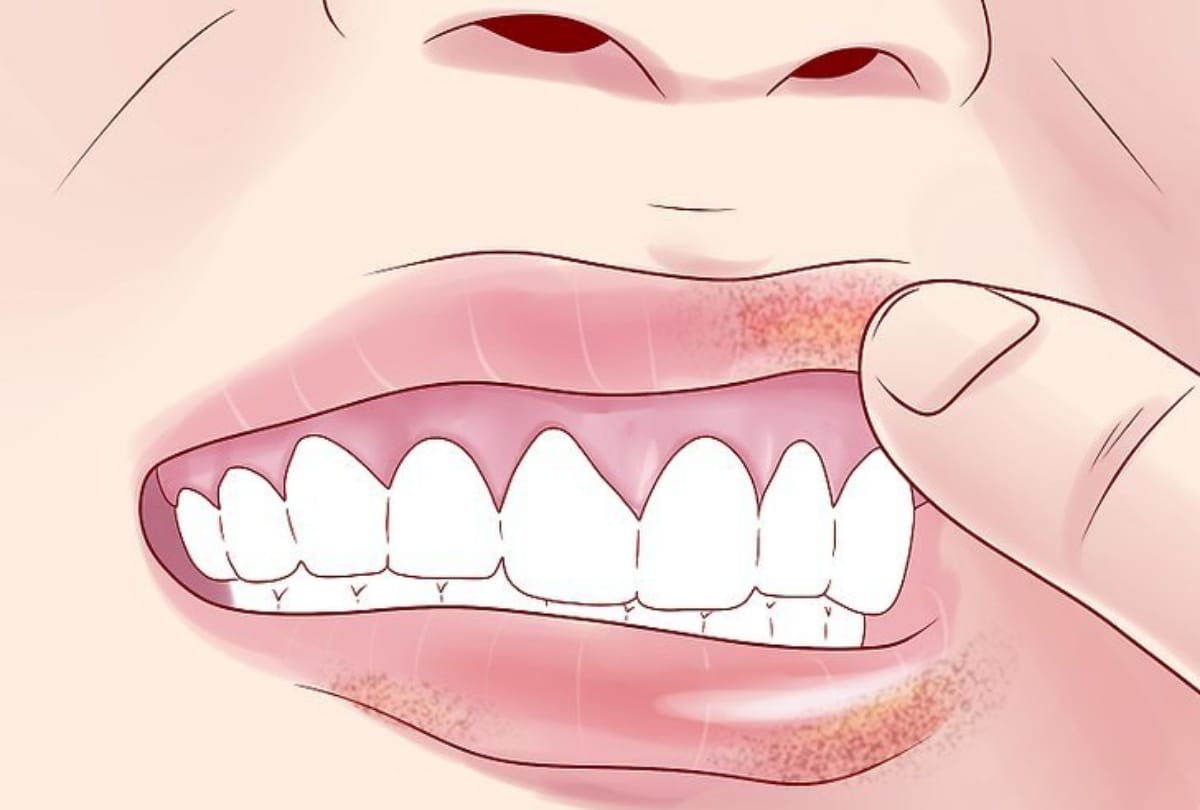 silent signs of Lip Cancer and its treatment 