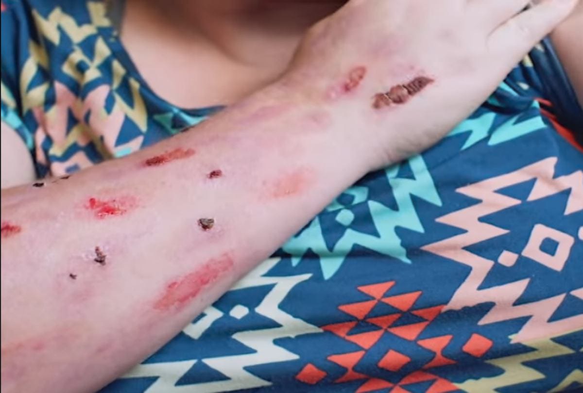 Women Suffering CRPS Or Suicide Disease Is Burning Every Day