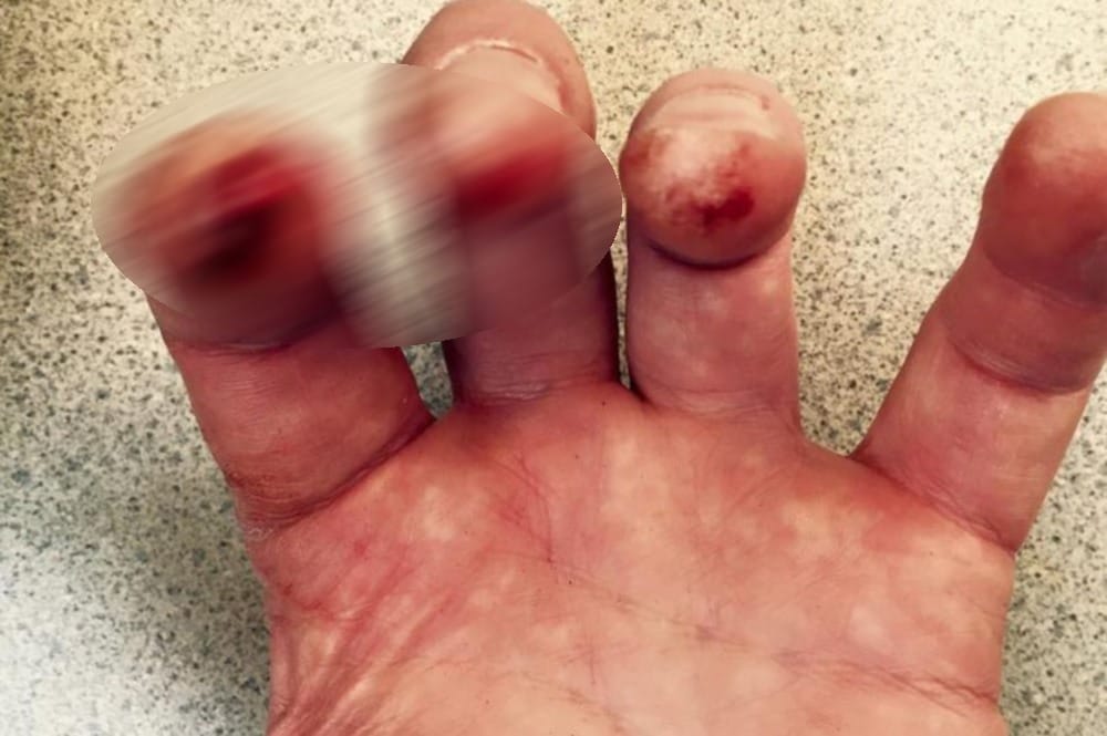 husband chews wife finger in anger