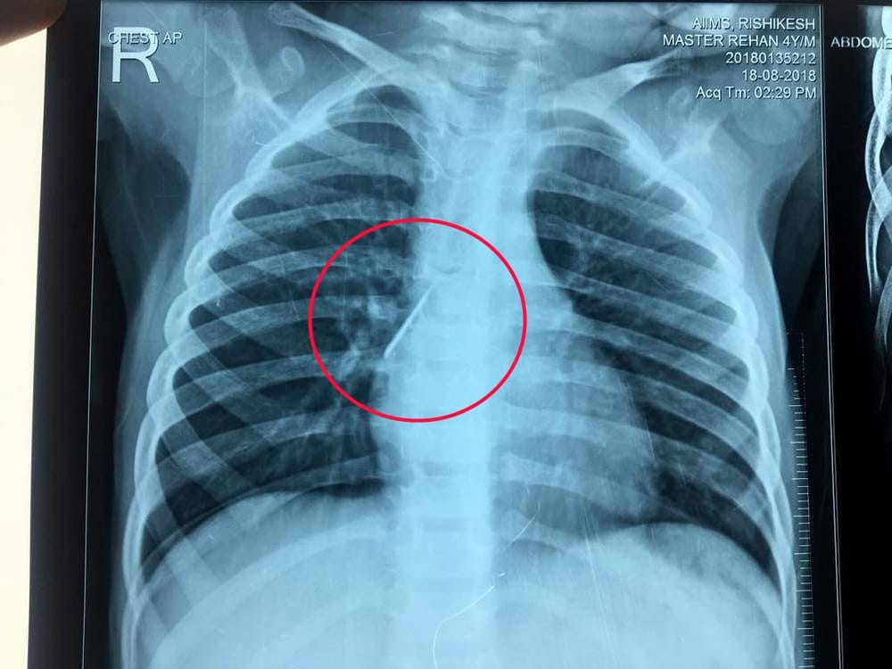 Pin in child Respiratory tube aiims rishikesh