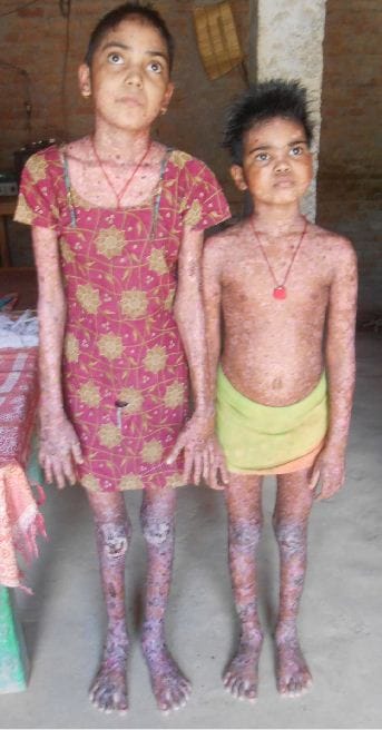 There are still many diseases of this disease, Teaching in school forbid agra