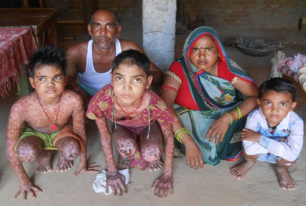There are still many diseases of this disease, Teaching in school forbid agra