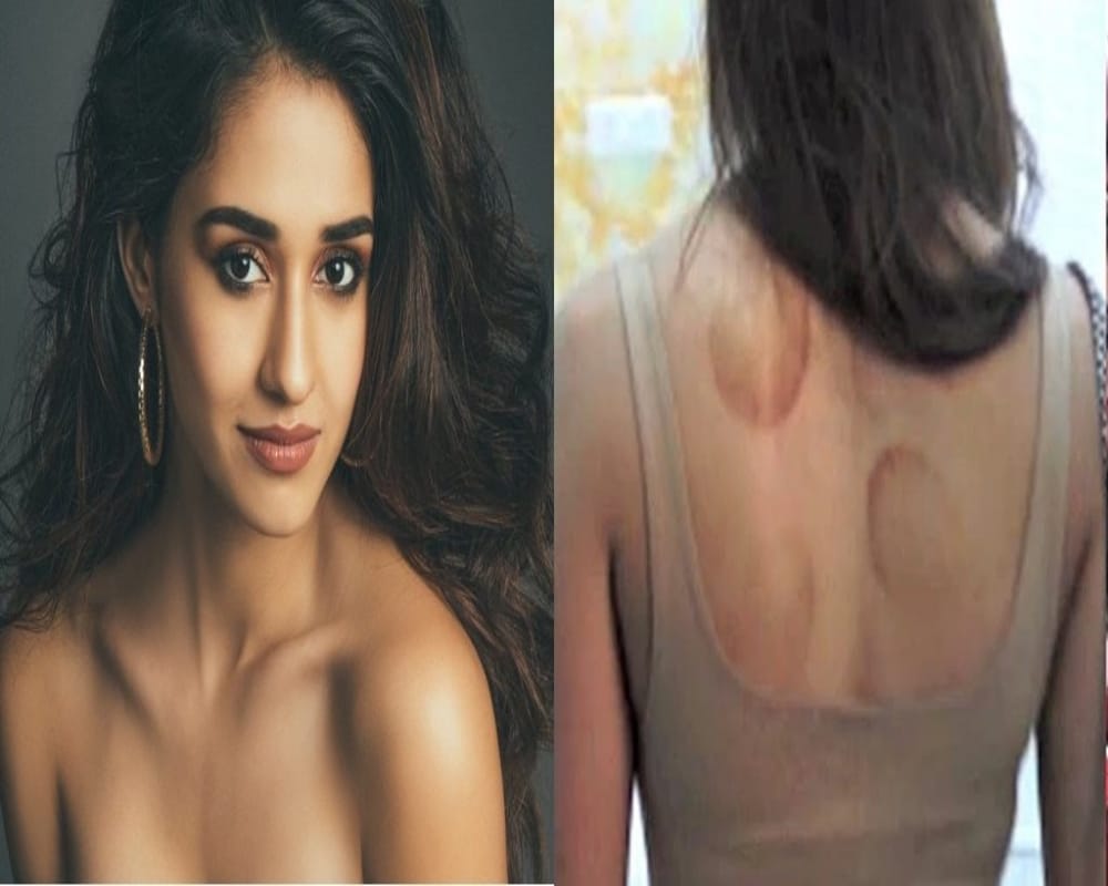 Know why Bollywood actress like disha patani are very fond of cupping therapy