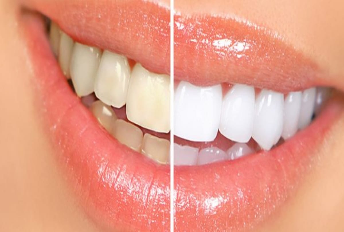 66 percent varanasi people suffering from tooth decay