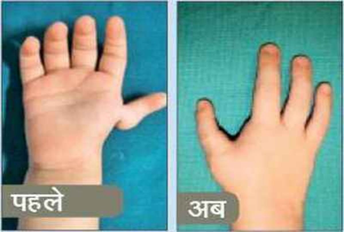 medical miracle of rare surgery of a finger