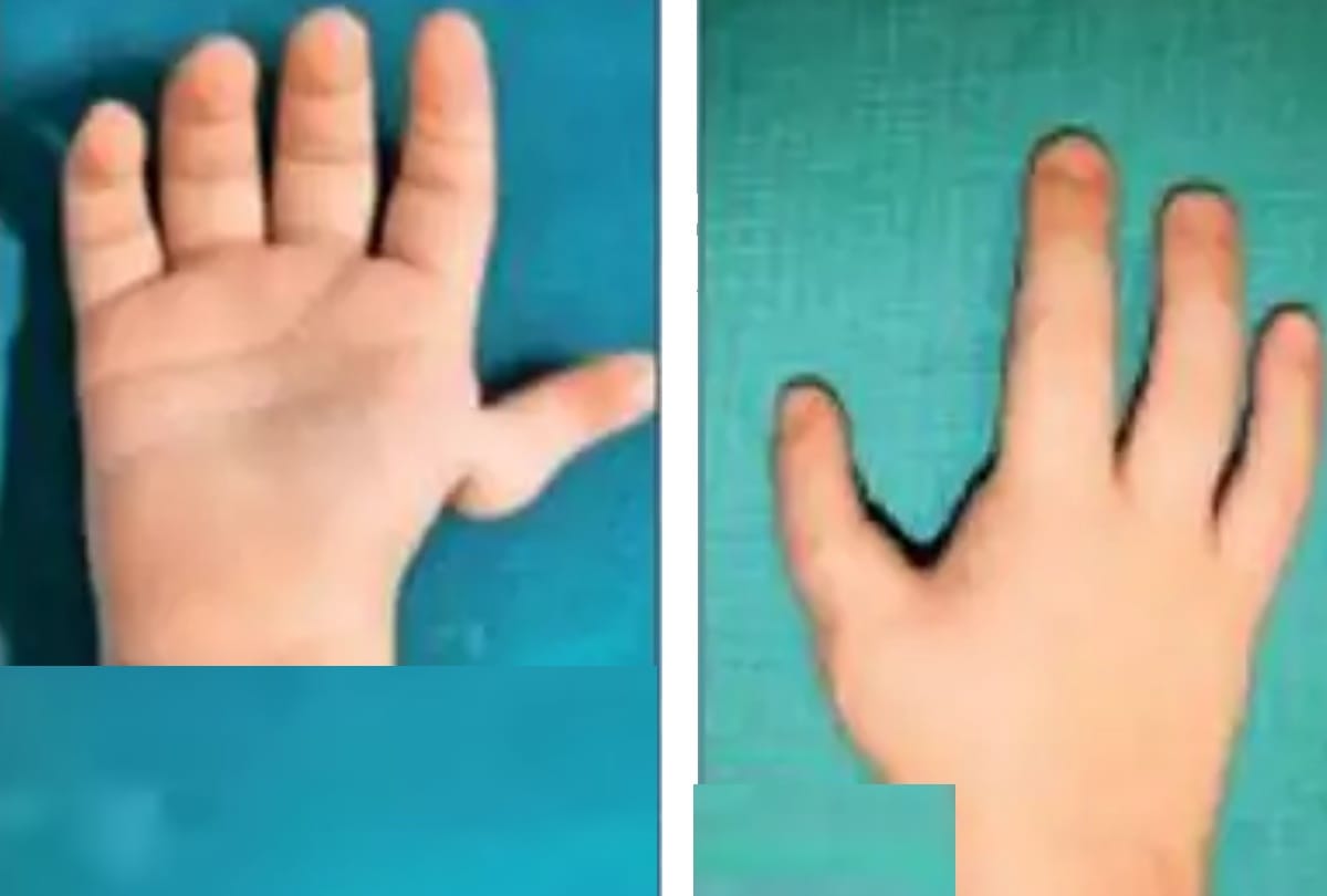 delhi hospital doctors rare surgery index finger converted in thumb