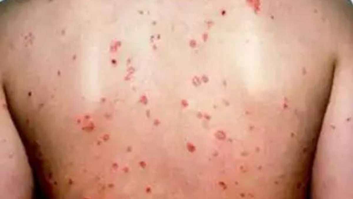 Ninety percent cleaners are suffering from skin diseases in varanasi