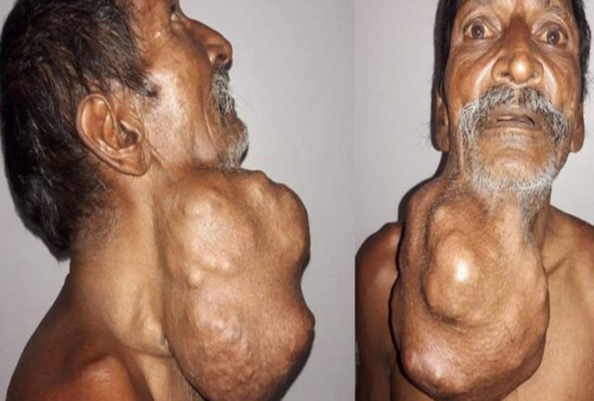 Farmer Saves Money to Have Surgery to Remove Tumor