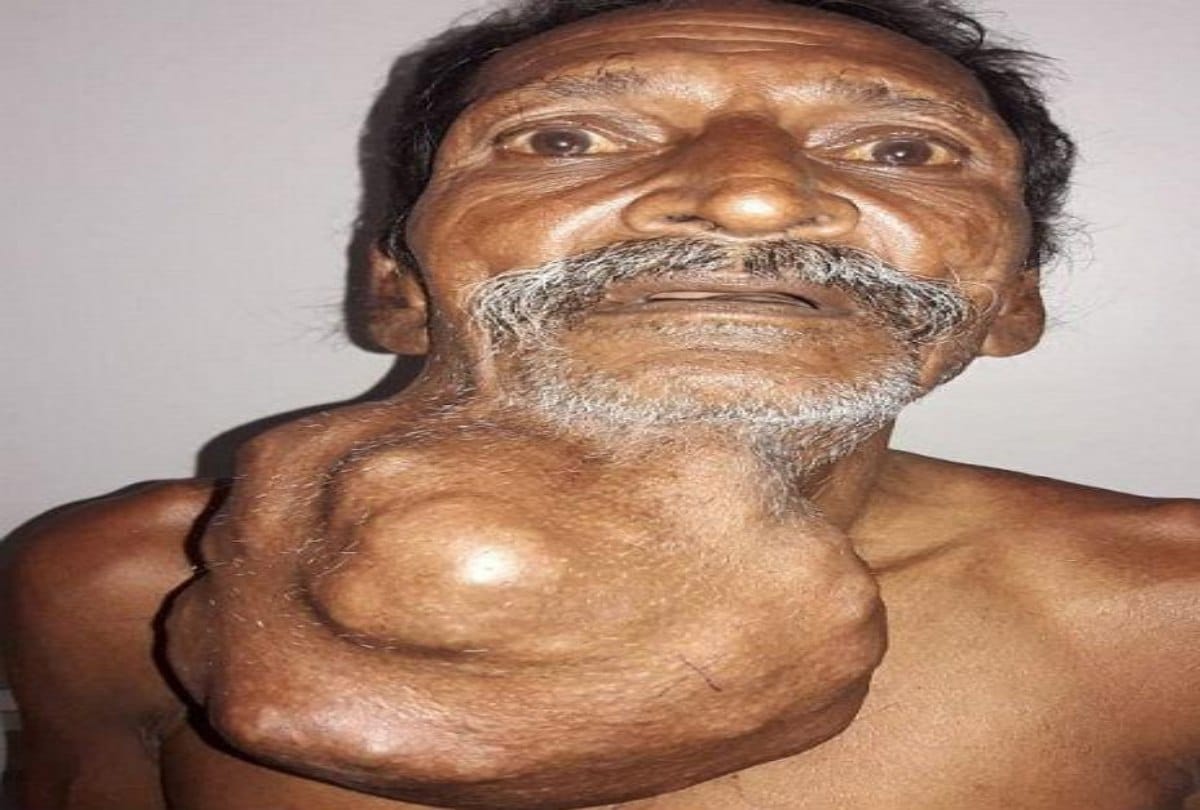 Farmer Saves Money to Have Surgery to Remove Tumor
