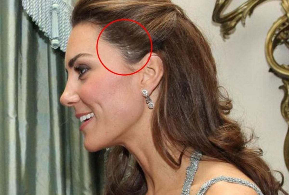 Harry Potter Scar On Britain Royals Prince William And Kate Middleton Know The Story Behind