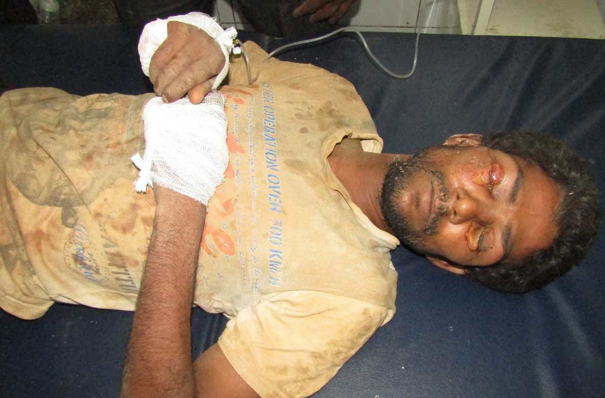 brutally attacked man with acid throwne in dump at sonebhadra
