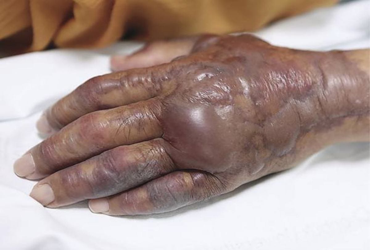 Man got skin infection After Eating Sushi At Restaurant In South Korea