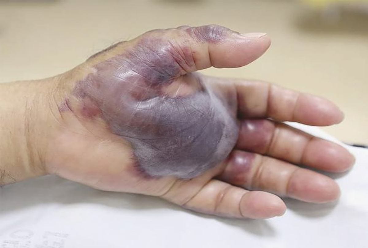 Man got skin infection After Eating Sushi At Restaurant In South Korea