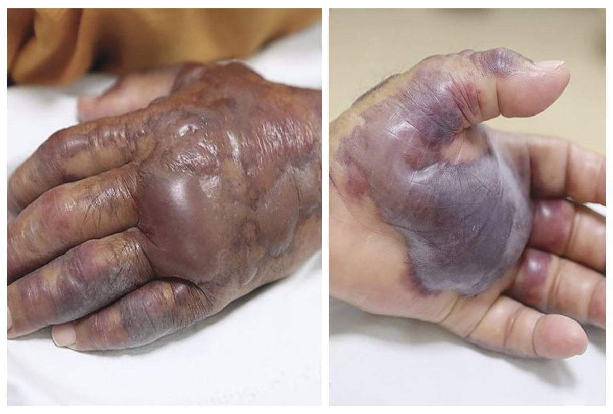 Man got skin infection After Eating Sushi At Restaurant In South Korea