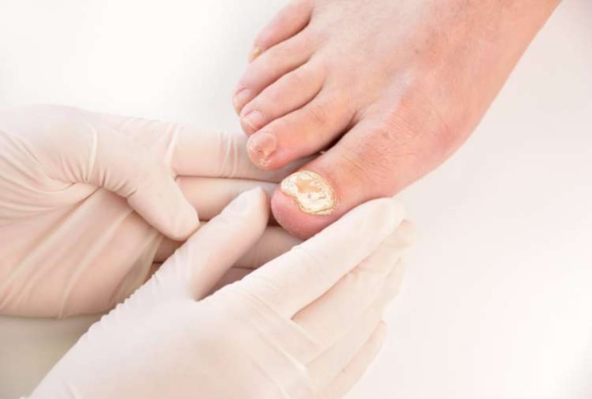 fungal infection increased in the changed season, hundreds of patients reaching the hospital daily