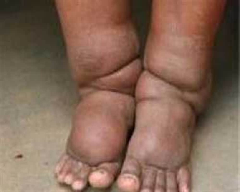 Home Remedies for Elephantiasis spread by mosquitoes