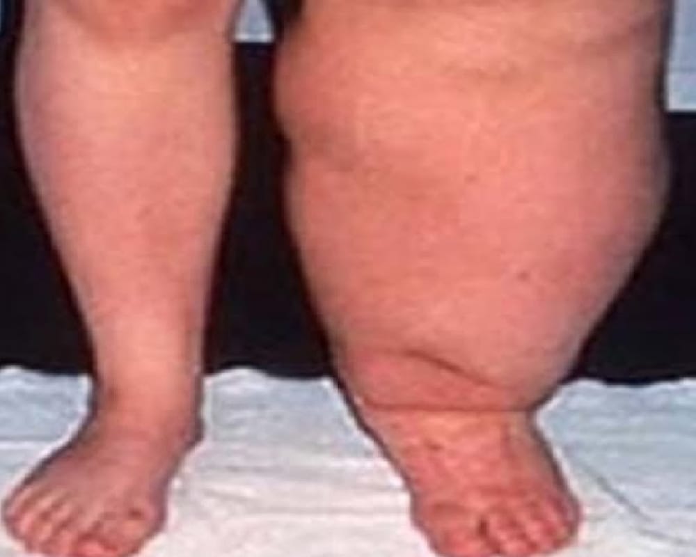 Elephantiasis Filaria: Not only Dengue malaria Elephantiasis Filaria is also caused by mosquitoes
