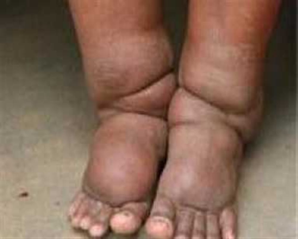 Elephantiasis Filaria: Not only Dengue malaria Elephantiasis Filaria is also caused by mosquitoes