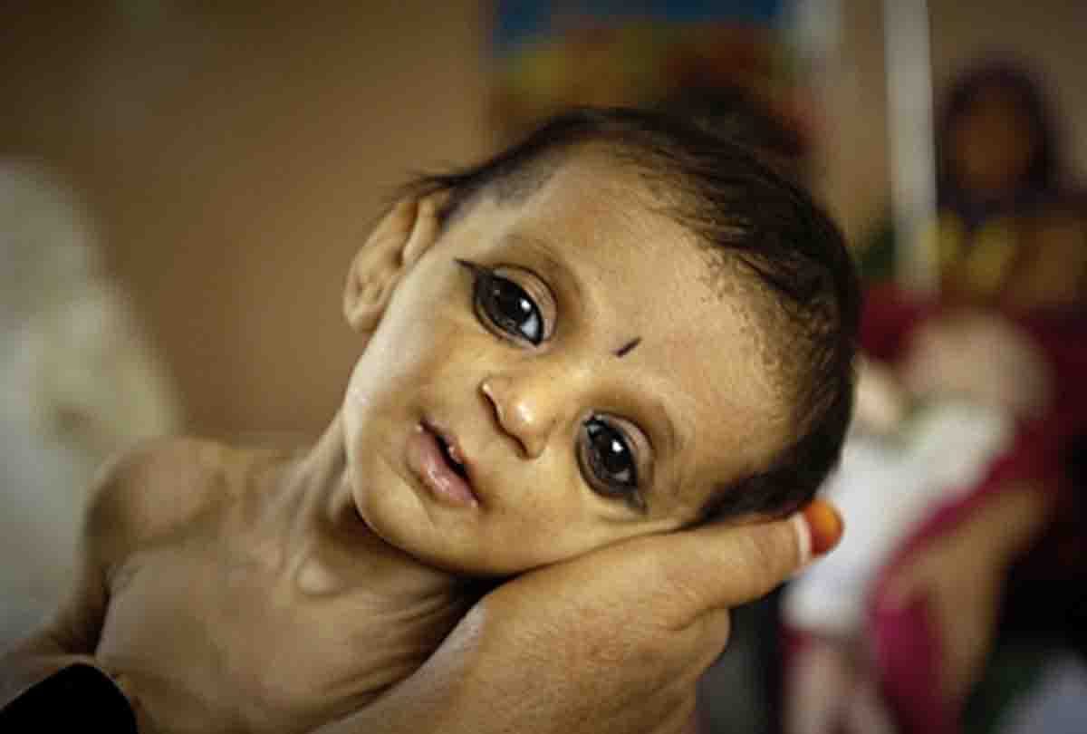 forty seven thousand children of Kanpur have lack of nutrition in the body
