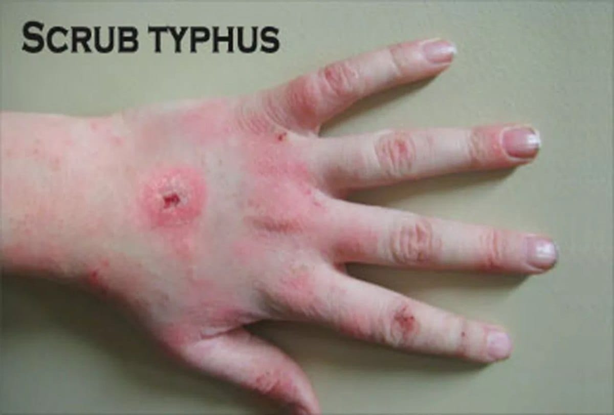 six people died due to scrub typhus in himachal