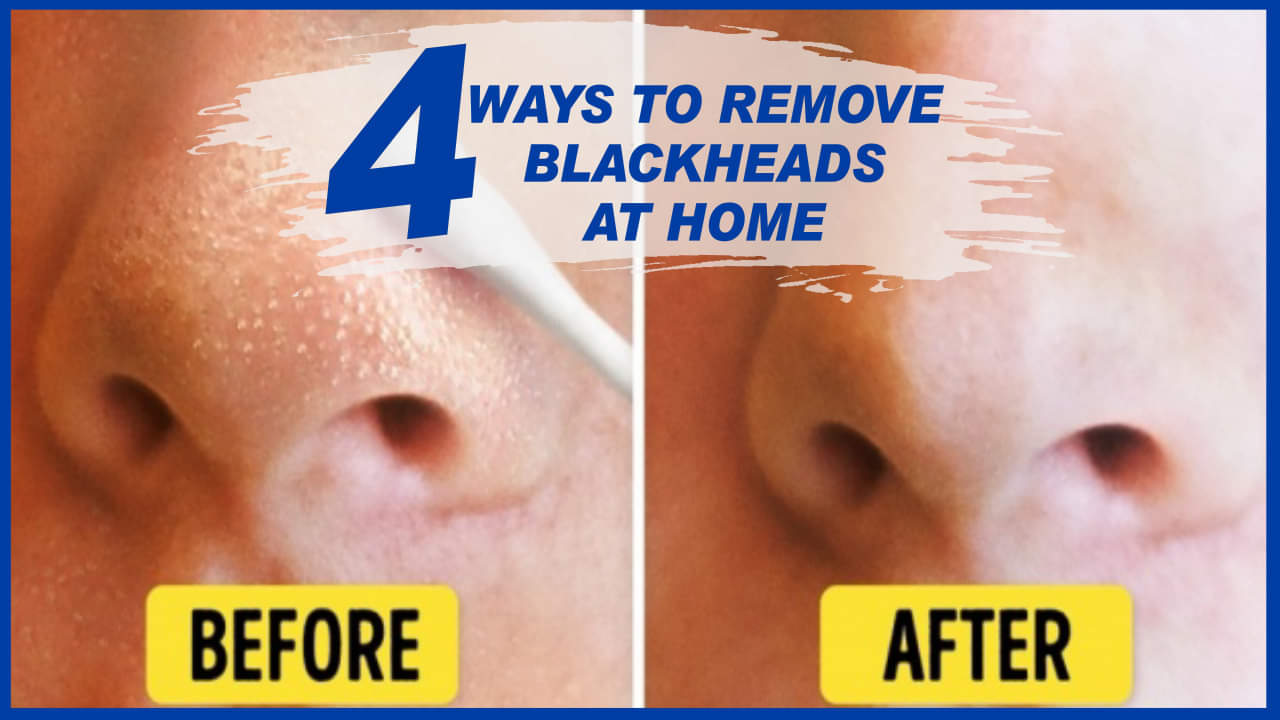 इन 4 तरीकों से घर बैठे आसानी से हटाएं ब्लैकहेड्स