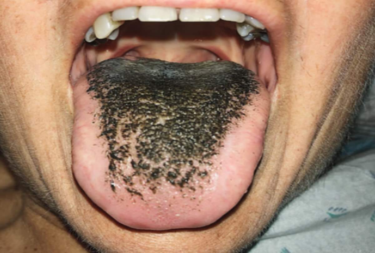 hair grew on women tongue after doctor gave antibiotics in Missouri in usa