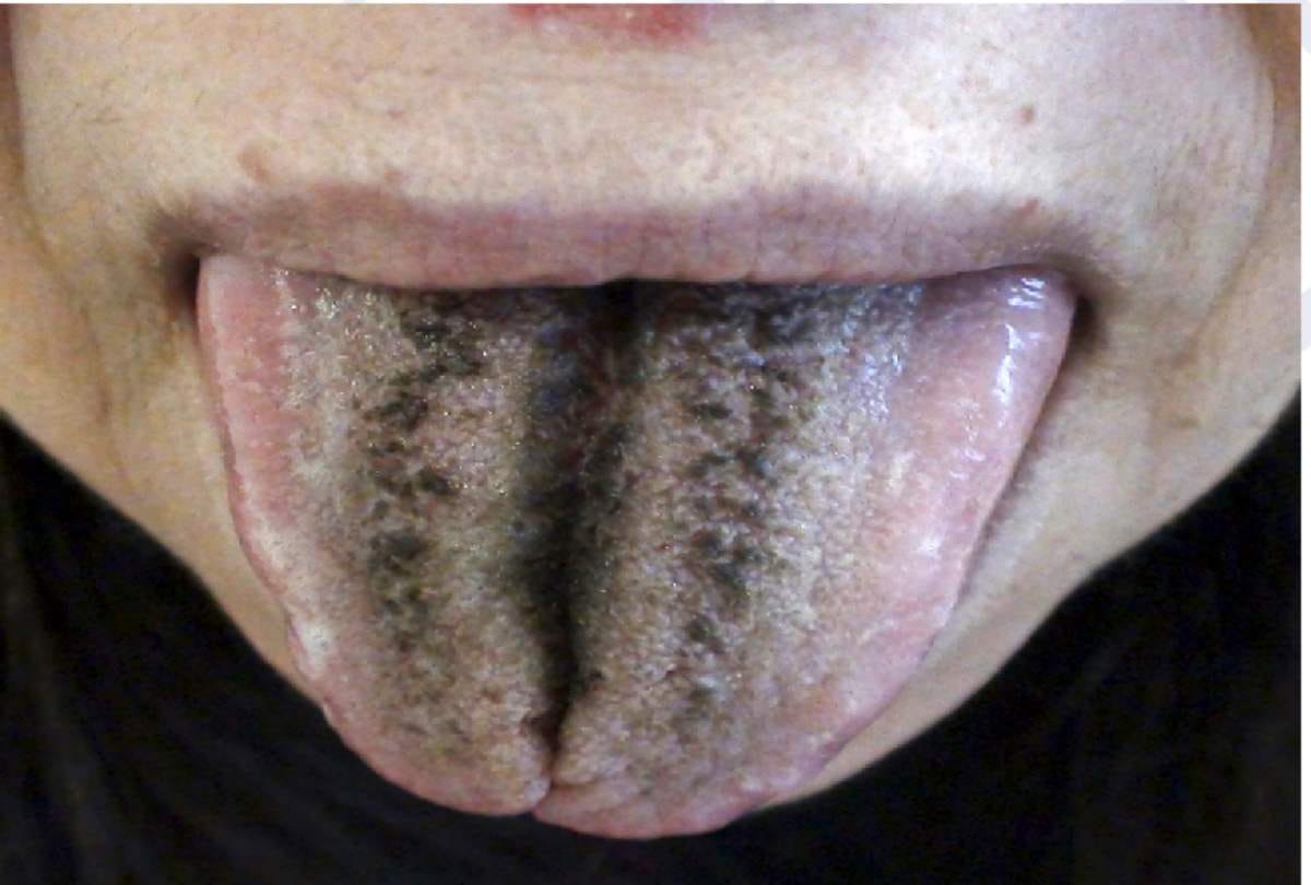 hair grew on women tongue after doctor gave antibiotics in Missouri in usa