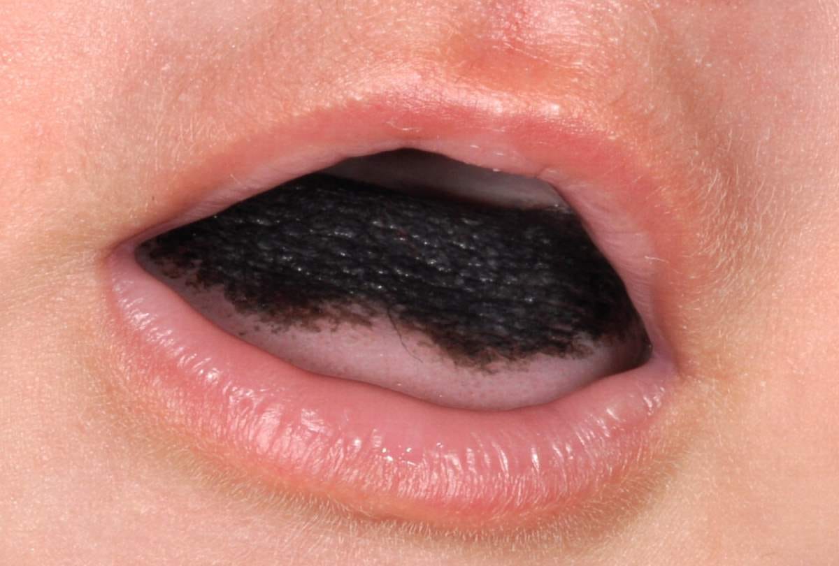 hair grew on women tongue after doctor gave antibiotics in Missouri in usa