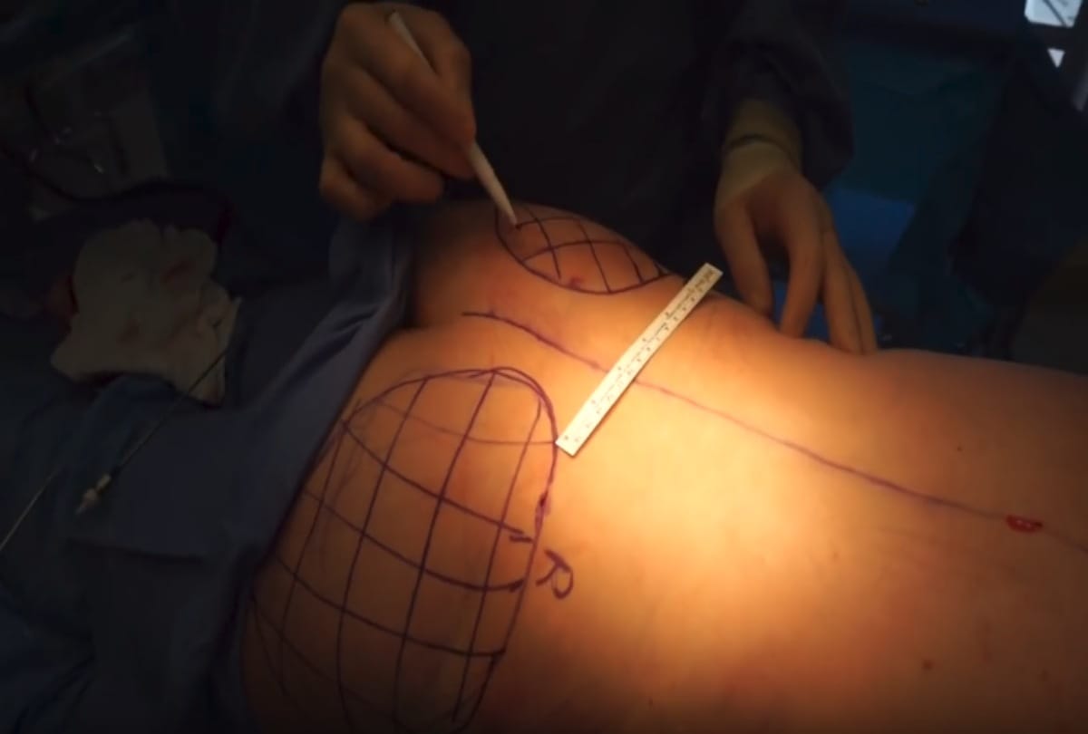 Know about the trend of butt upliftment surgery