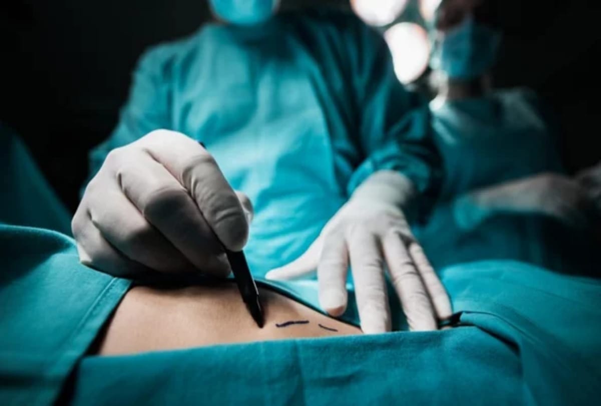 Know about the trend of butt upliftment surgery