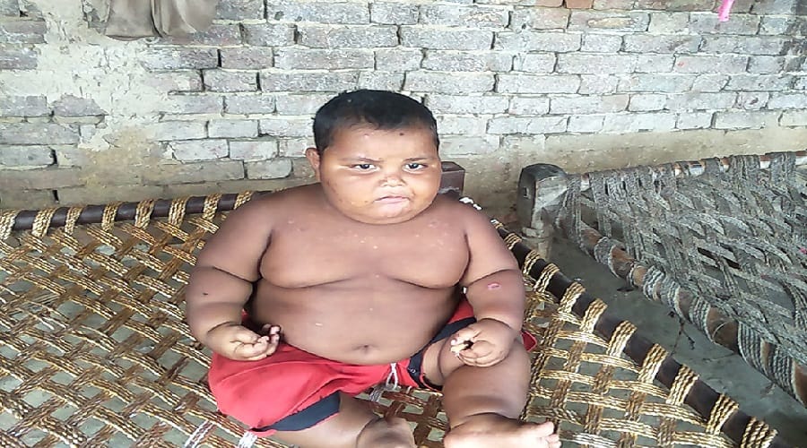 Two year old child has weighed 26 kg and doctors are shocked
