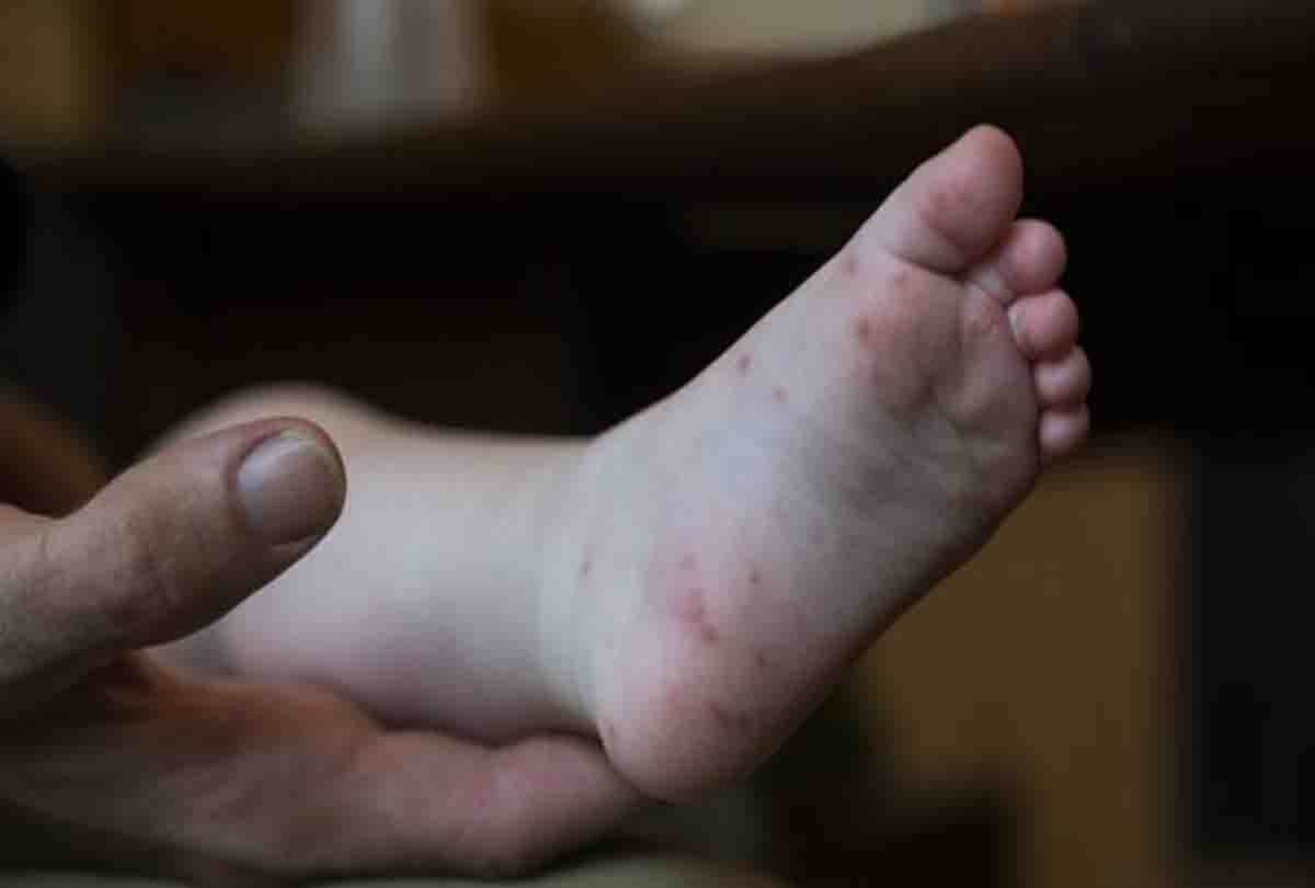 Found first Hand Foot Mouth Disease in children of Kanpur city