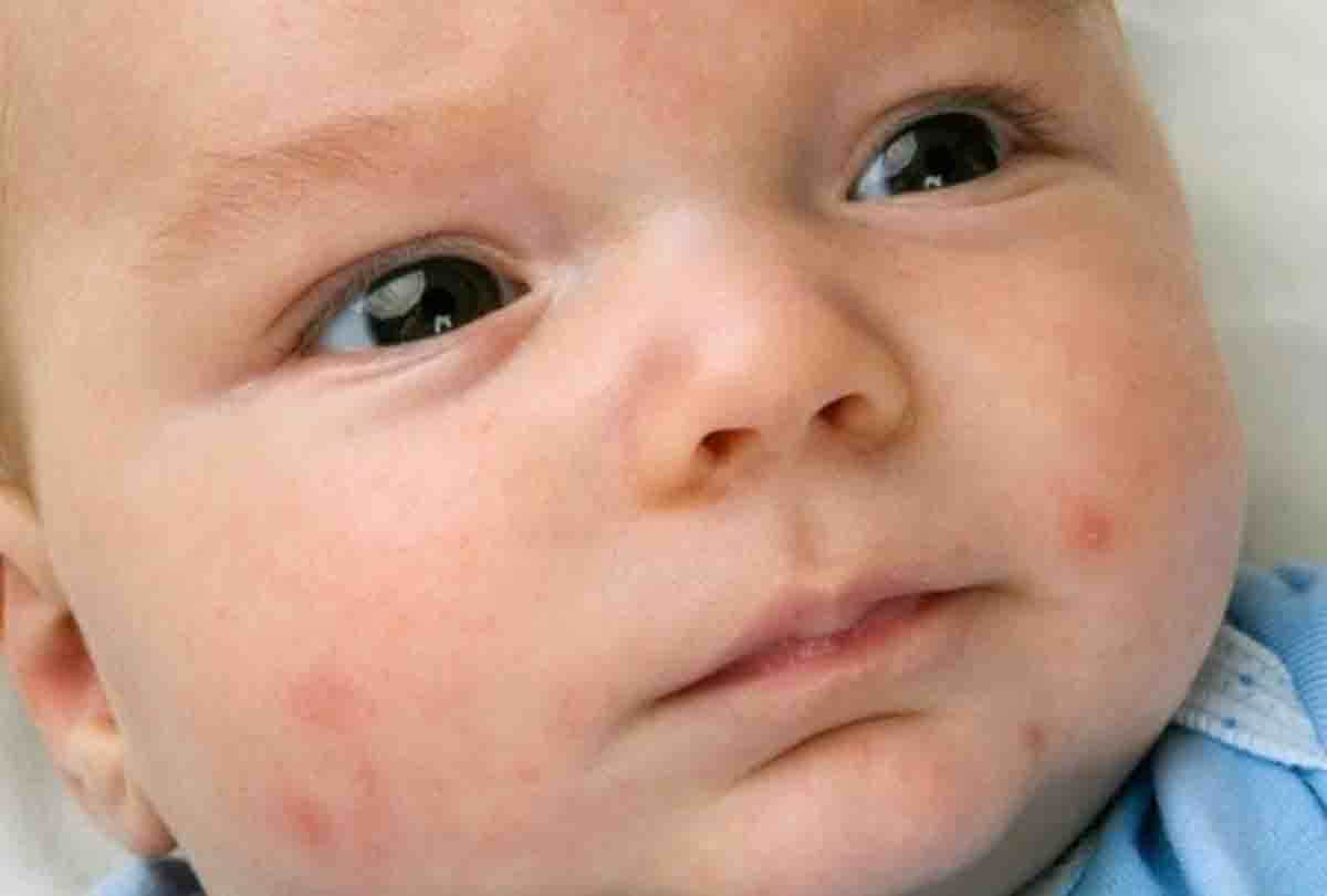 Found first Hand Foot Mouth Disease in children of Kanpur city