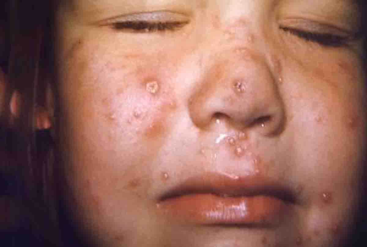 Found first Hand Foot Mouth Disease in children of Kanpur city