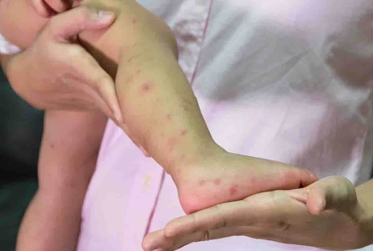 Found first Hand Foot Mouth Disease in children of Kanpur city