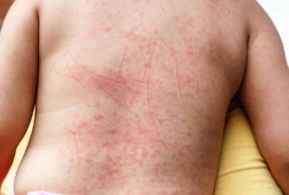 Dengue and Chikungunya Symptoms and treatment