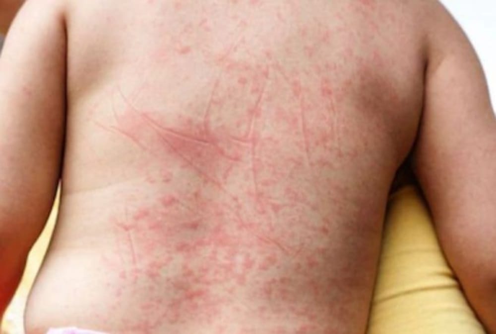 Dengue and Chikungunya Symptoms and treatment