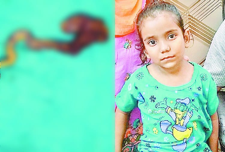 Rare Surgery of Six Years Old Girl Child Stomach, Bunch of Hairs Found, doctors Amazed