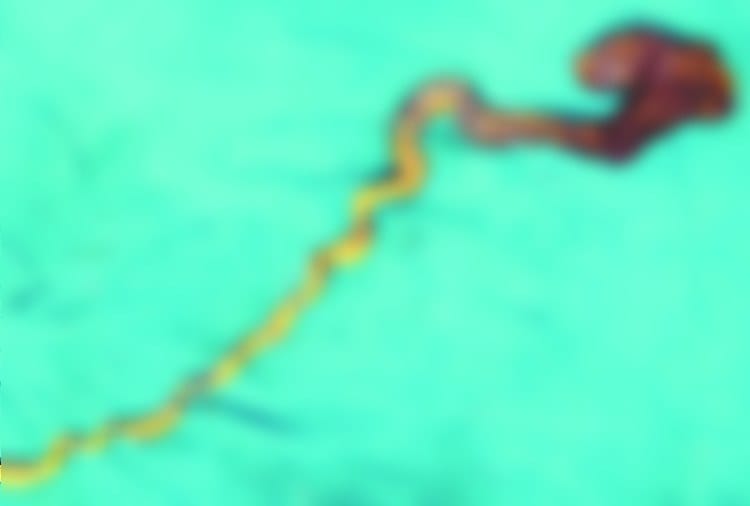 Rare Surgery of Six Years Old Girl Child Stomach, Bunch of Hairs Found, doctors Amazed