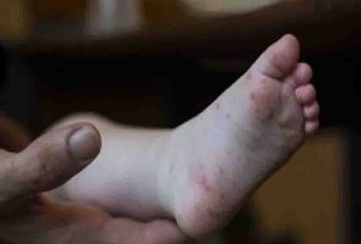 Hand Foot Mouth Disease spreading in children of Kanpur city