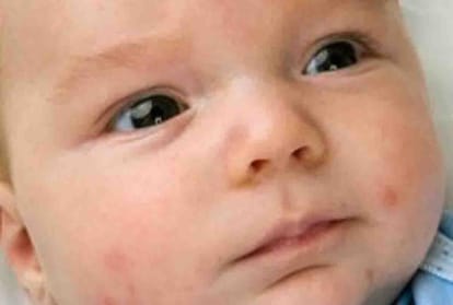 Hand Foot Mouth Disease spreading in children of Kanpur city