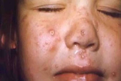 Hand Foot Mouth Disease spreading in children of Kanpur city