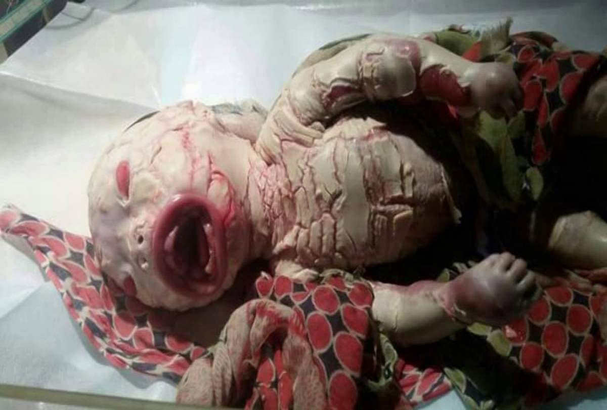 delhi Kasturba Gandhi Hospital weird baby born with Harlequin ichthyosis disorder